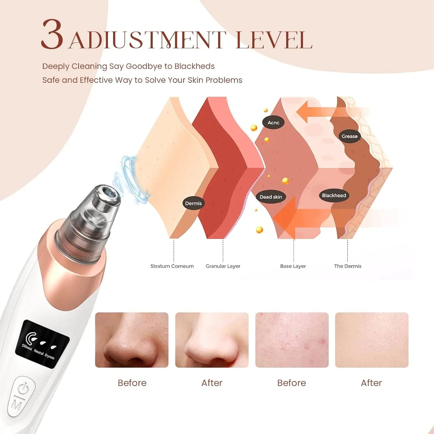 5-in-1 Blackhead remover | blackhead remover machine